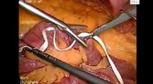 Laparoscopic Choledochal cyst 