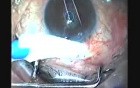 Canoacrylate In Managing Flat AC After Trabeculectomy