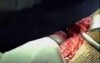 Hip Replacement Surgery