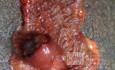 Ascending Colon Intussusception due to a Adenocarcinoma (5 of 6)