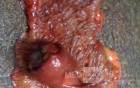 Ascending Colon Intussusception due to a Adenocarcinoma (5 of 6)
