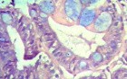 Barrett's Esophagus of long segment (24 of 24)