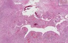 Lung - Wegener Granulomatosis