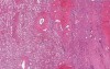 Wilms tumor - Histopathology - Kidney