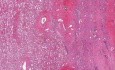 Wilms tumor - Histopathology - Kidney