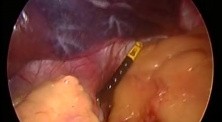 Laparoscopic gastric banding