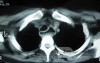 Esophagus - Pneumatic Dilation for Achalasia (31 of 31)