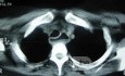 Esophagus - Pneumatic Dilation for Achalasia (31 of 31)