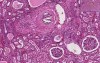 Atheroemboli - Histopathology of kidney