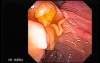 Villous Adenoma of Vater Papilla