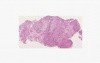 Mesothelioma - Histopathology - Lung, pleura