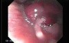 Hemangioma of the larynx