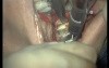 Harvest From Ramus Of Mandibula (1/2)