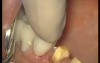 Glass Ionomer Cementation (3/6)