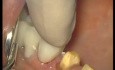 Glass Ionomer Cementation (3/6)