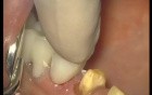 Glass Ionomer Cementation (3/6)