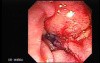 Adenocarcinoma of Papilla of Vater (2 of 5)