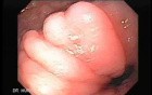 Intestinal Metaplasia - Endoscopy (3 of 5)