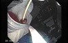Endoscopic Resection of Giant Tubulo-Villous of the rectum (20 of 35)