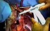 Human Cardiovascular System, Diseases And Heart Transplantation