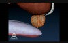 Enlarged Prostate - 3D Medical Animation
