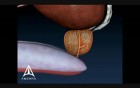 Enlarged Prostate - 3D Medical Animation