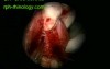 Right Maxillary Sinus Lesion