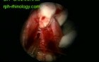 Right Maxillary Sinus Lesion