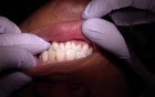 Temporary Implant Crown - Eliminate Excursive Contacts