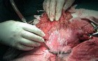 Plastic Linitis with bilateral Krukenberg´s tumor (7 of 13)
