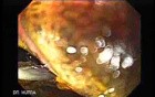 Barrett Esophagus - endoscopic view  (7 of 9)