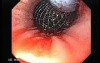 Failed Placement Of The Esophageal Stent