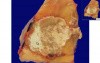 Interphalangeal Joint Of Toe - Gout