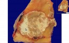 Interphalangeal Joint Of Toe - Gout