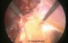 Laparoscopic Incisional Hernia Repair