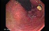 Status Post Rubber Band Ligation for Internal Hemorrhoids (4 of 7)