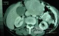 Gastric Ulcer with Gastrocolic fistula due to a Zollinger-
 Ellison Syndrome (27 of 33)