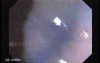 Sessile Tubulovillous Adenoma (7 of 13)