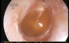 Otitis Media with Effusion or Glue Ear