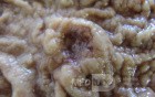 Adenocarcinoma of the Antrum and incisura angularis (7 of 12)