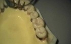 Ultrasonic Endoscopic  Debridement Simulation (LR)