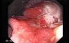 Multiple Adenomatous Polyps Of The Rectum (18 of 37)