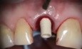 Failing Upper Central, Immediate Implant And Provisional