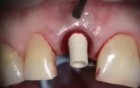 Failing Upper Central, Immediate Implant And Provisional