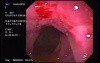 Crohn's Disease - Endoscopy (2 of 28)