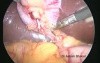 Three-Port Laparoscopic Cholecystectomy