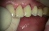 Immediate Implant #11 With Complications