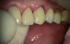 Immediate Implant #11 With Complications