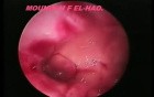 Contraception Complication - Penetration of Myometrium by the Intrauterine Device