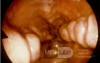 Esophageal Varices- Endoscopic Image
